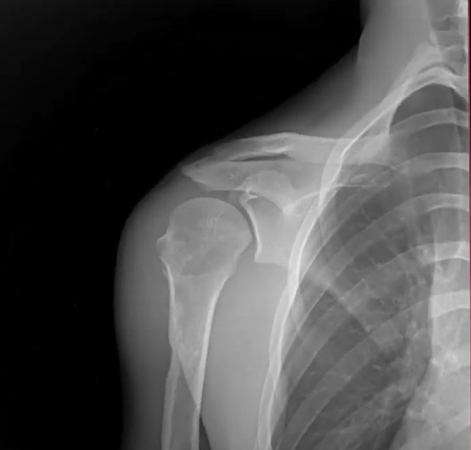 Shoulder x-ray from DDR system 1 of 3