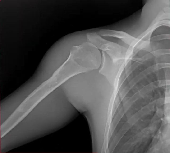 Shoulder x-ray from DDR system 2 of 3