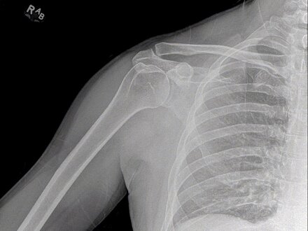 shoulder x-ray single frame from a DDR movie