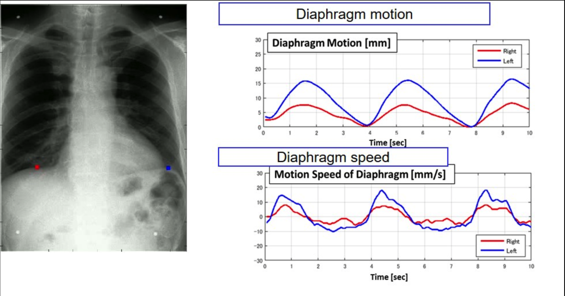 diaphragm motion recorded with DDR 