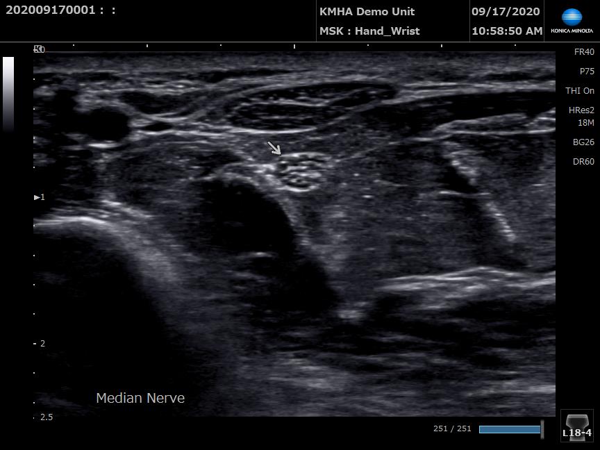 HS2 Median Nerve Scan