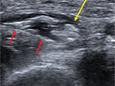 MSK Ultrasound Guided Nerve Hydrodissections