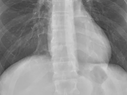 AeroDR HD Chest Image High Dynamic Range