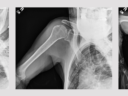 sample images from a series of shoulder x-rays from the dynamic digital radiography software