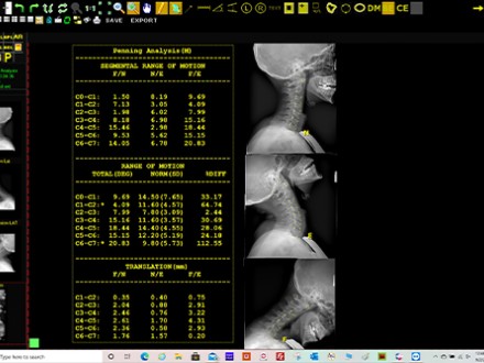 Opal-Chiro Pennings Analysis scree