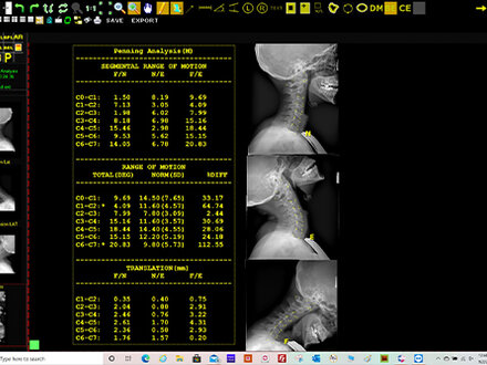 Opal-Chiro Pennings Analysis scree