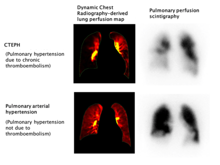 CTEPH diagnosis with Digital Digital Radiography