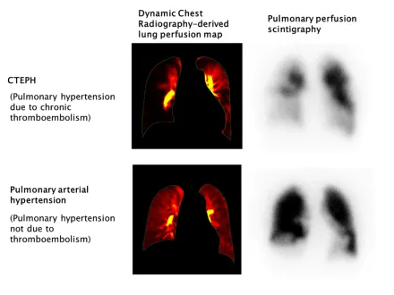 CTEPH diagnosis images produced using Dynamic Digital Radiography