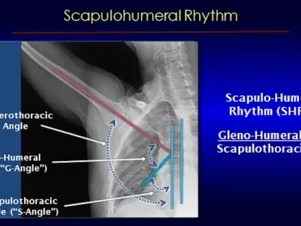 An x-ray from dynamic digital radiography of the shoulder 