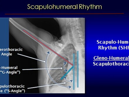 An x-ray from dynamic digital radiography of the shoulder