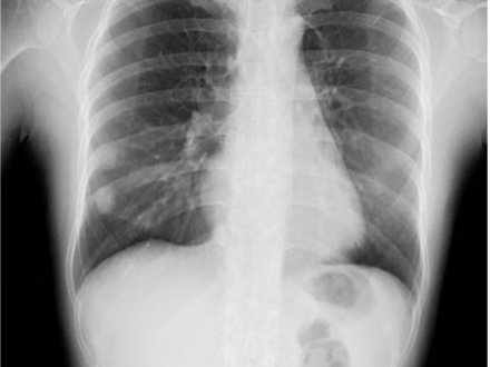 DDR Teaser Images - Thorax