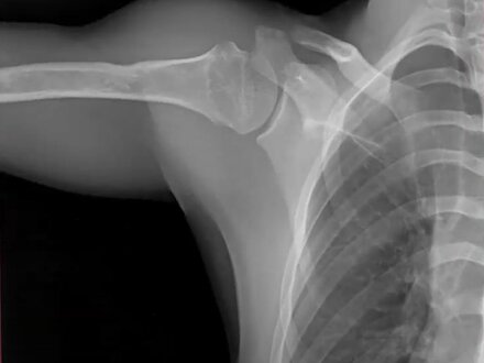 Shoulder x-ray from DDR system 3 of 3