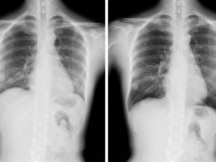 Images from a DDR acquisition (visualization of anatomy in motion) of a patient breathing, demonstrating (left) inhalation and (right) exhalation.