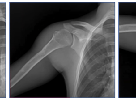 A series of shoulder X-rays showing how DDR works