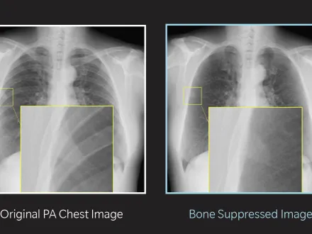 A side-by-side image of an X-ray before and after applying BSI software