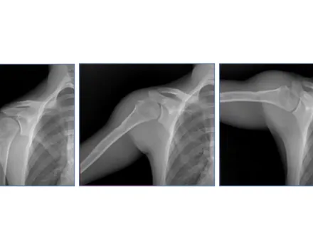A series of X-ray images showing movement in a shoulder