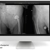 zero footprint vieweer screen showinig hip x-ray
