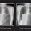 Original Lung Image versus Bone Suppressed Lung Image