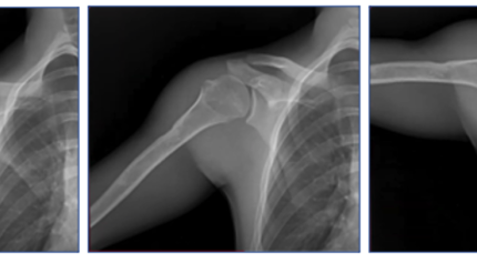 A series of shoulder X-rays showing how DDR works