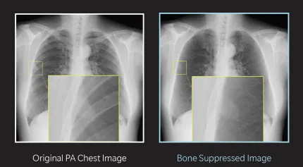 A side-by-side image of an X-ray before and after applying BSI software