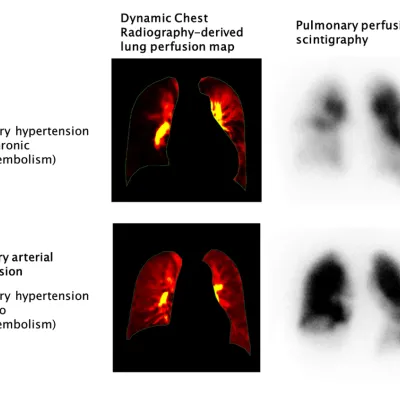 CTEPH diagnosis with Digital Digital Radiography