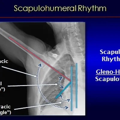 An x-ray from dynamic digital radiography of the shoulder 