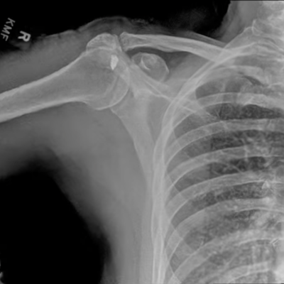 DDR Teaser Images - Scapula