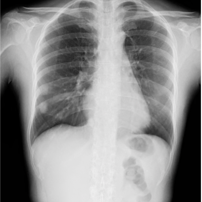 DDR Teaser Images - Thorax