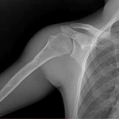 Shoulder x-ray from DDR system 2 of 3