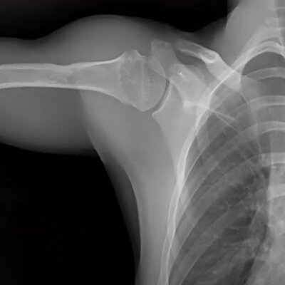 Shoulder x-ray from DDR system 3 of 3