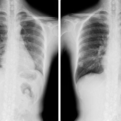 Images from a DDR acquisition (visualization of anatomy in motion) of a patient breathing, demonstrating (left) inhalation and (right) exhalation.