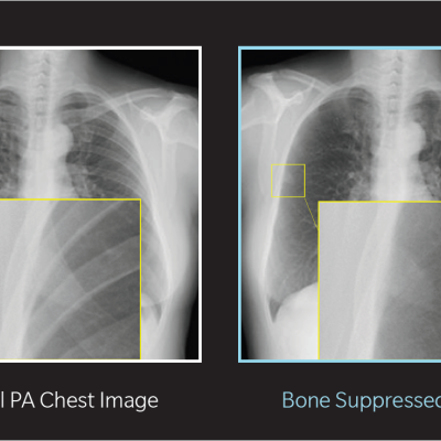 Original Lung Image versus Bone Suppressed Lung Image