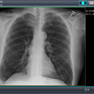 A screen capture of a chest image on CS7