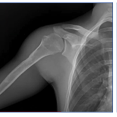A series of shoulder X-rays showing how DDR works
