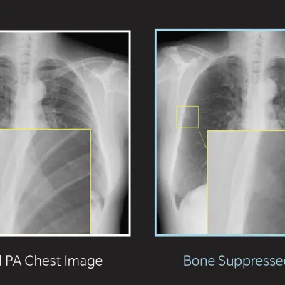 A side-by-side image of an X-ray before and after applying BSI software
