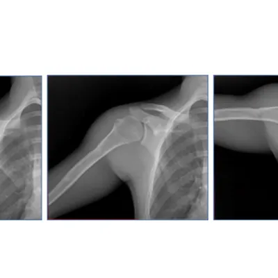 A series of X-ray images showing movement in a shoulder