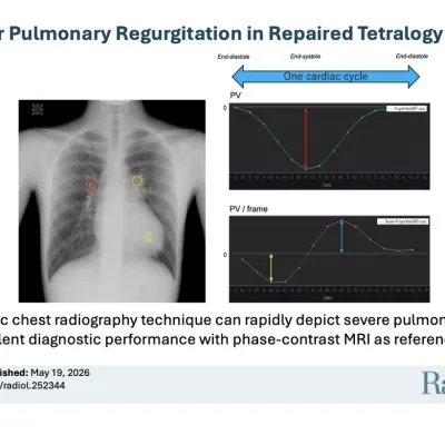 An image and data to support the study about DDR in Pulmonary Regurgitation