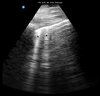 ultrasound image of lungs