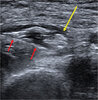 MSK Ultrasound Guided Nerve Hydrodissections