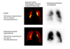 CTEPH diagnosis with Digital Digital Radiography