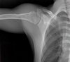 Shoulder x-ray from DDR system 3 of 3