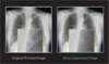 Original Lung Image versus Bone Suppressed Lung Image