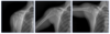A series of shoulder X-rays showing how DDR works