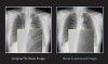 A side-by-side image of an X-ray before and after applying BSI software
