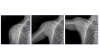 A series of X-ray images showing movement in a shoulder